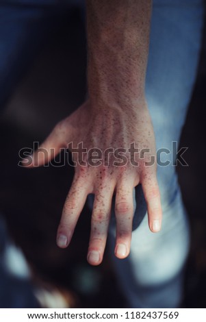 Freckles. Man with freckles. Photo of a hand
