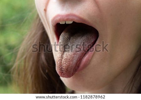 Woman black hairy tongue out of mouth