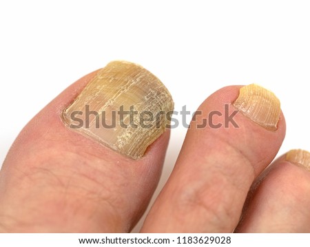 Toenail fungus, onychomycosis, foot in front of white background Royalty-Free Stock Photo #1183629028