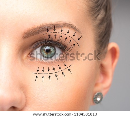 Blepharoplasty treatment on female eye Royalty-Free Stock Photo #1184581810