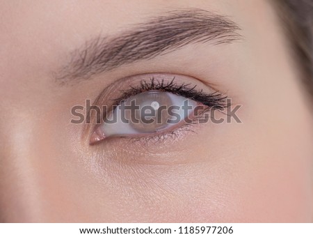 Eye of a woman with cataract and corneal opacity Royalty-Free Stock Photo #1185977206