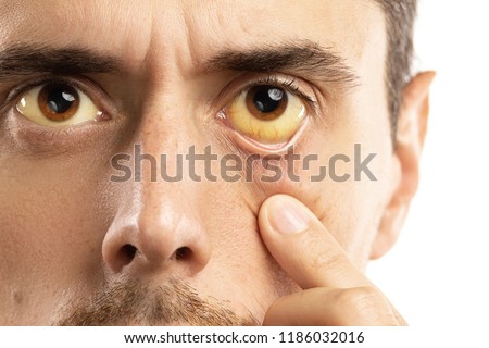 Man checking his health condition. Yellowish eyes is sign of problems with liver, viral infection or other disease. Royalty-Free Stock Photo #1186032016