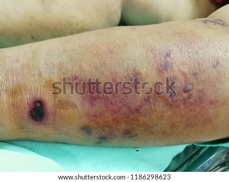 infected left leg, necrotizing fasciitis Royalty-Free Stock Photo #1186298623