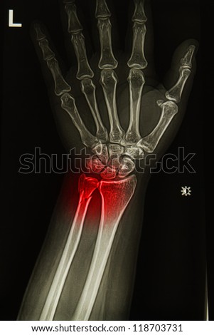 injury or painful of wrist joint  x-rays image
