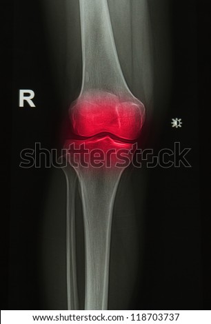  x-rays image of  the painful or injury knee joint