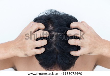 Young man suffering from itching her head, Itching scalp.