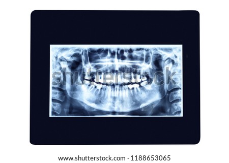 X-ray photo of teeth. Isolated on white background