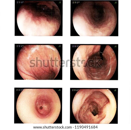 Reported gastrointestinal endoscopic examination. medical image.
