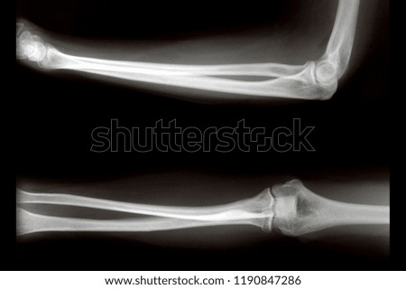 X-ray medical picture - Elbow and forearm