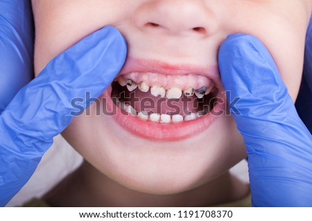 Dental medicine and healthcare - dentist examining little child girl patient open mouth showing caries teeth decay Royalty-Free Stock Photo #1191708370