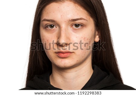 teenage girl with problematic skin on white background Royalty-Free Stock Photo #1192298383