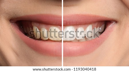 Smiling woman before and after teeth whitening procedure, closeup Royalty-Free Stock Photo #1193040418