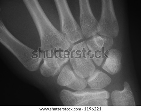 Wrist X-ray, showing the different wrist bones.