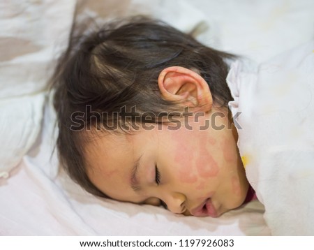 Baby with symptoms of itchy urticaria at face. Royalty-Free Stock Photo #1197926083