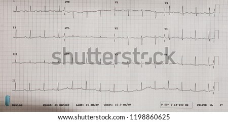 AV-NODAL-DISEASE Stock Photos and Images - Avopix.com