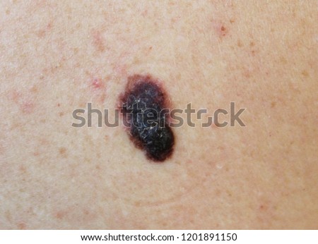 Melanoma - a malignant tumor of human skin Royalty-Free Stock Photo #1201891150