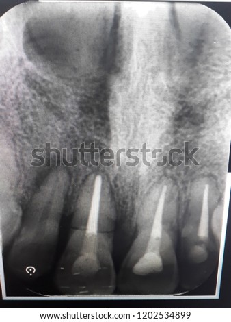 X-ray tooth crack