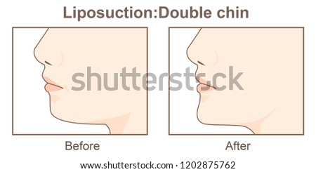 Liposuction operation-Double chin 