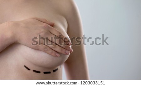 Marks for augmentation surgery on ladys breast, human body alteration trend