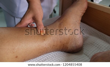 Piiting Oedema with Hyperpigmented Lower Limbs in patient with hypoalbuminemia. Royalty-Free Stock Photo #1204855408