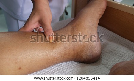 Piiting Oedema with Hyperpigmented Lower Limbs in patient with hypoalbuminemia. Royalty-Free Stock Photo #1204855414
