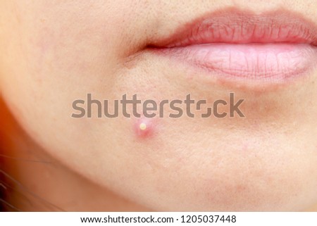 check skin and acne closeup Royalty-Free Stock Photo #1205037448