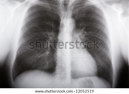 xray picture of human male lungs