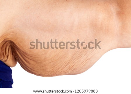 Middle aged woman with sagging arm skin after extreme weight loss. Inspiration for poster and meme, before brachioplasty, panniculectomy, abdominoplasty and mummy makeover in Australia.