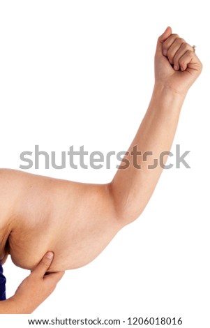 Middle aged woman with sagging excess arm skin extreme weight loss. Inspiration for poster and meme, before brachioplasty, panniculectomy, abdominoplasty and mummy makeover in Australia.
