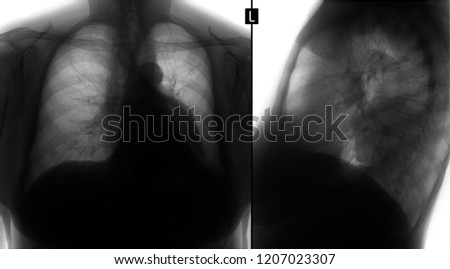 X-ray of the lungs. Volume formation of the mediastinum. Enterogenous cyst. Negative.