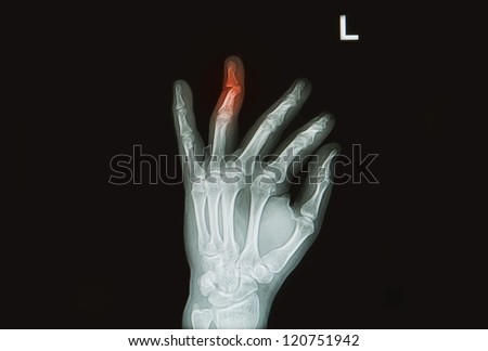 injury or pain full of  hand and finger x-rays image