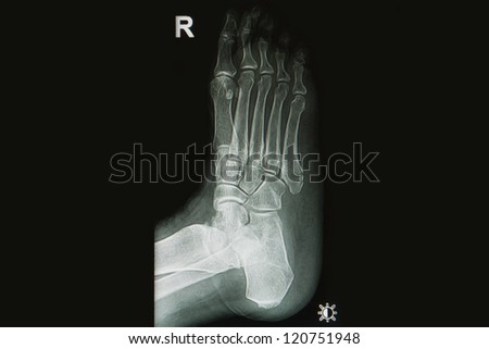  x-rays image of  injury  foot and toe fracture