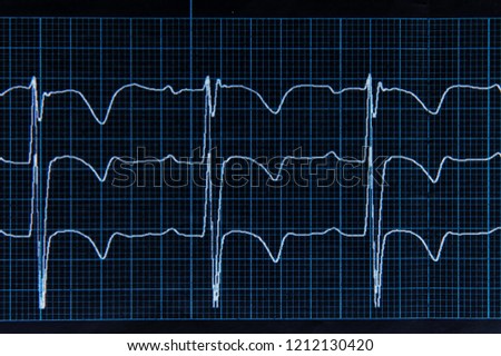 Close up, top view. Medical research. ECG. The heartbeat lines on the monitor screen are blue.