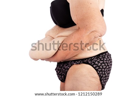 Middle aged woman with sagging skin after babies and extreme weight loss. Inspiration for poster and meme, before brachioplasty, panniculectomy, abdominoplasty and mummy makeover in Australia. Royalty-Free Stock Photo #1212150289