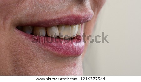 beautiful smile by zircon crowns