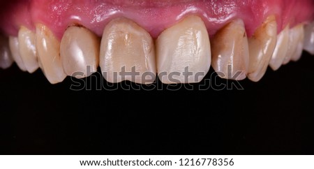 beautiful smile by zircon crowns