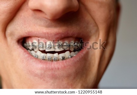 Man with dental braces on his teeth of the upper and lower jaw close up. Orthodontics and bite correction