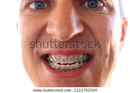 Man with dental braces on his teeth of the upper and lower jaw close up. Orthodontics and bite correction