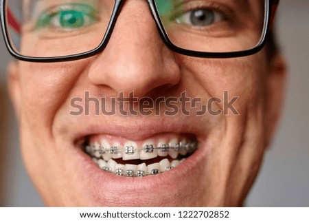Man with brackets dental. Braces on his teeth with smile and glasses
