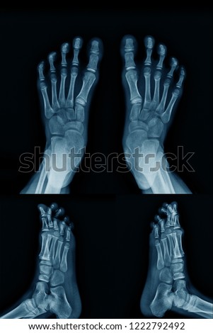 x-ray foot both side with lateral view both side in blue tone 