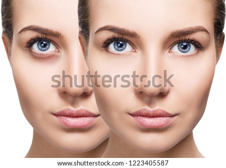 Female eyes with bruises under eyes before and after cosmetic treatment. Over white background.