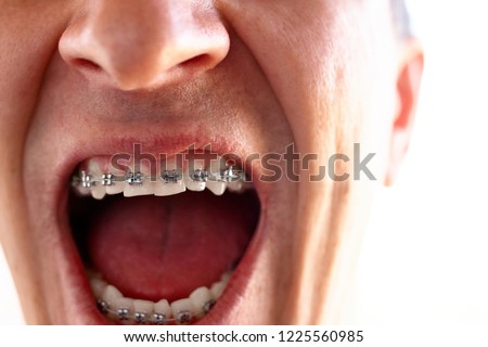 Man with an open mouth with dental braces on the teeth of the upper and lower jaws close-up in dentistry. Orthodontics and bite correction