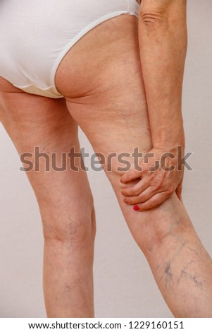 An elderly woman in white panties shows places with cellulite and varicose veins on a light isolated background. Concept for medicine and cosmetology.