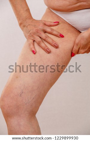 Elderly woman in underwear shows closeup on varicose veins on her legs. Photo on a light isolated background. Concept for medicine and cosmetology.
