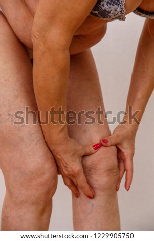 Elderly woman in underwear shows closeup on varicose veins on her legs. Photo on a light isolated background. Concept for medicine and cosmetology.