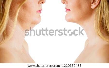 Double chin fat or dewlap correction, before and after Royalty-Free Stock Photo #1230332485