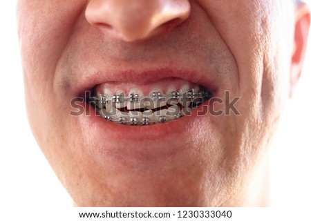 Portrait of an adult thirty year old man with dental brackets on the teeth of the upper and lower jaw close-up. Orthodontics and bite correction