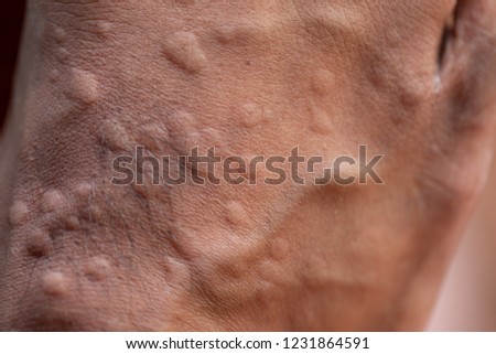 The lesion on foot after caused by ants bites (Red imported fire ant).