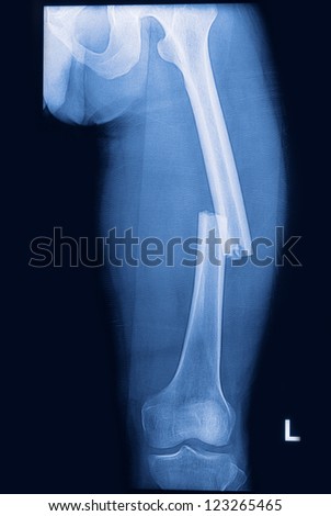 broken human thigh x-rays image ,Left leg fracture Royalty-Free Stock Photo #123265465