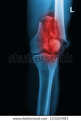 broken human thigh x-rays image ,Left leg fracture Royalty-Free Stock Photo #123265483